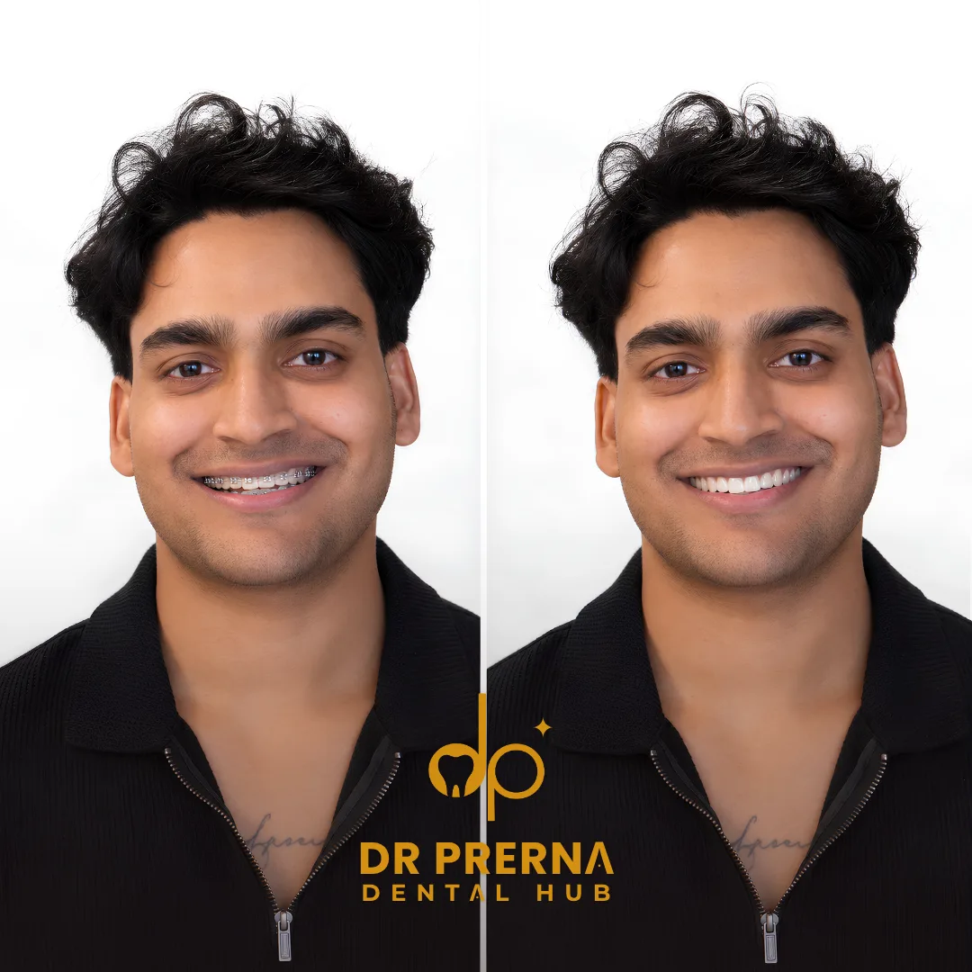 Before and after smile makeover result 2 at Dr. Prerna Dental Hub, Rohini