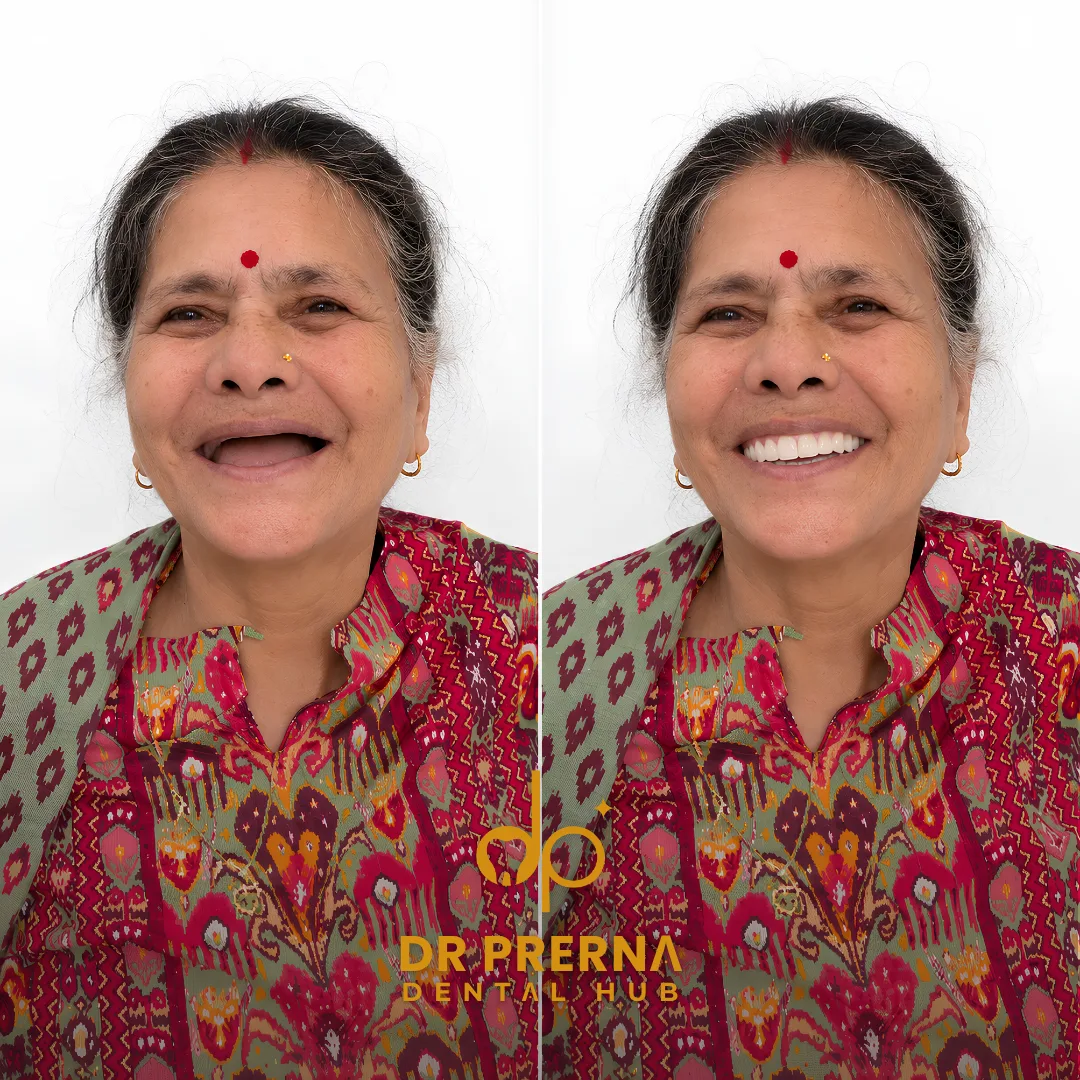 Before and after smile makeover result 3 at Dr. Prerna Dental Hub, Rohini