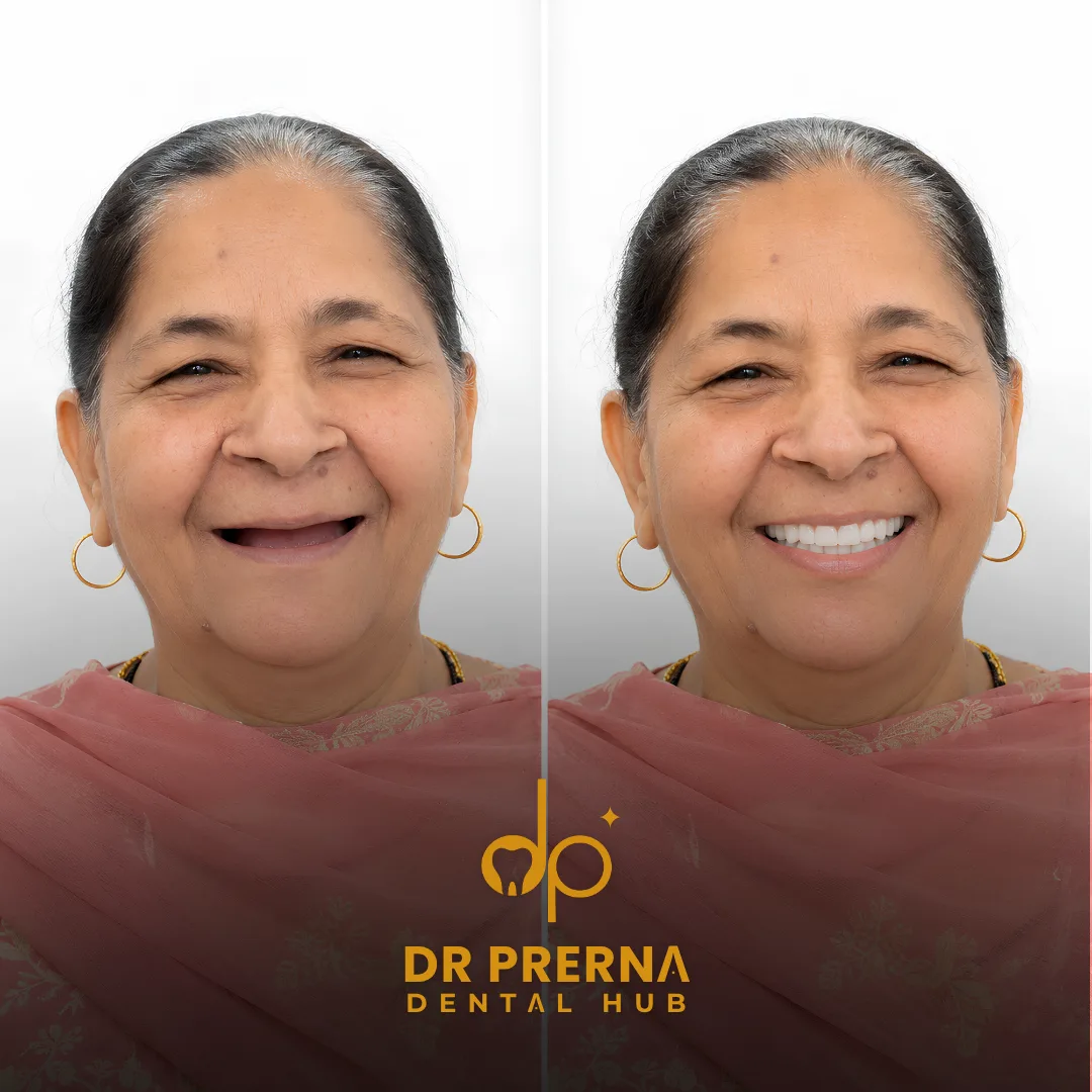 Before and after smile makeover result 4 at Dr. Prerna Dental Hub, Rohini