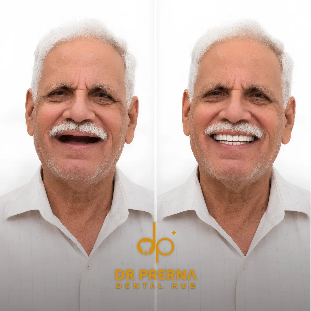 Before and after smile makeover result 5 at Dr. Prerna Dental Hub, Rohini