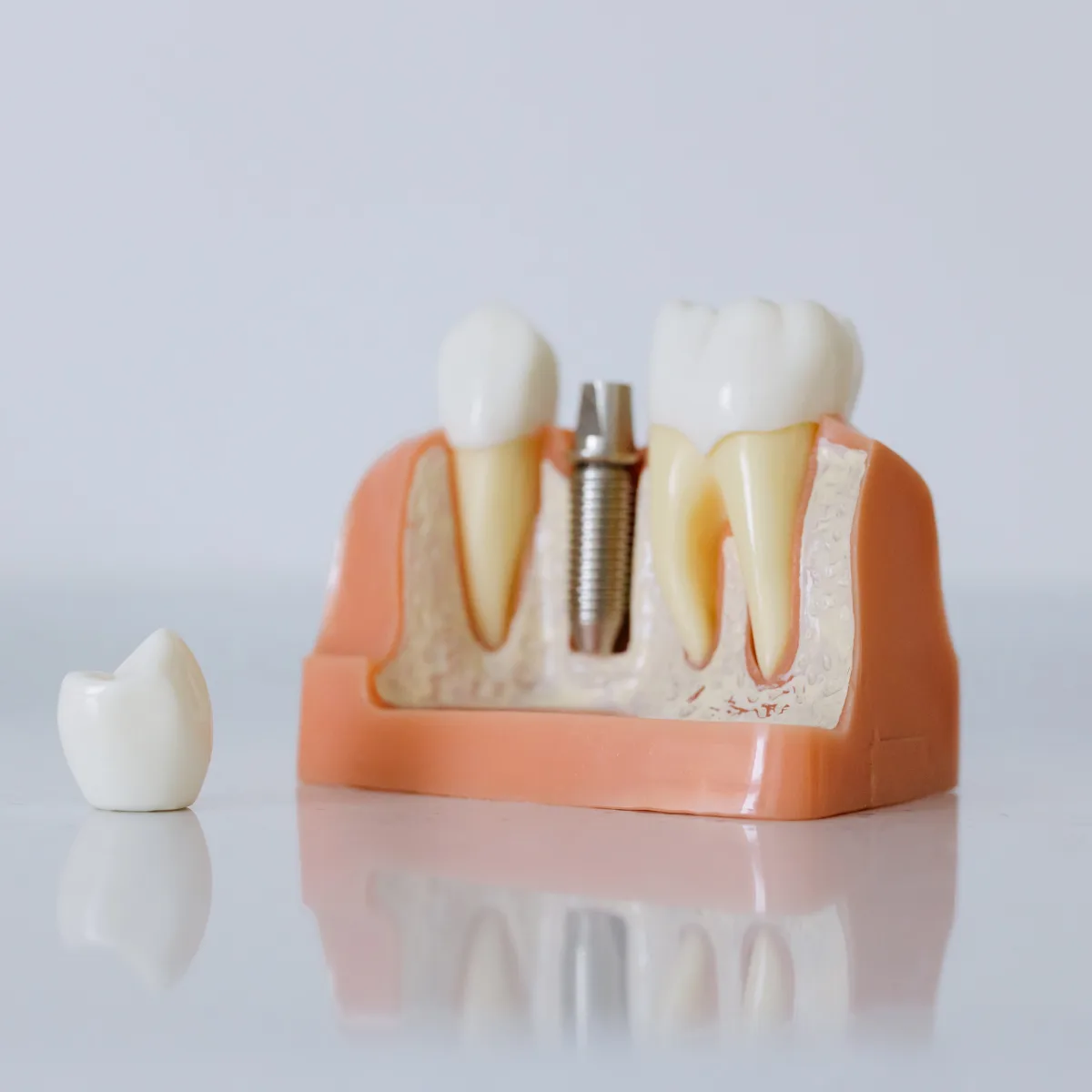 Dental Implants