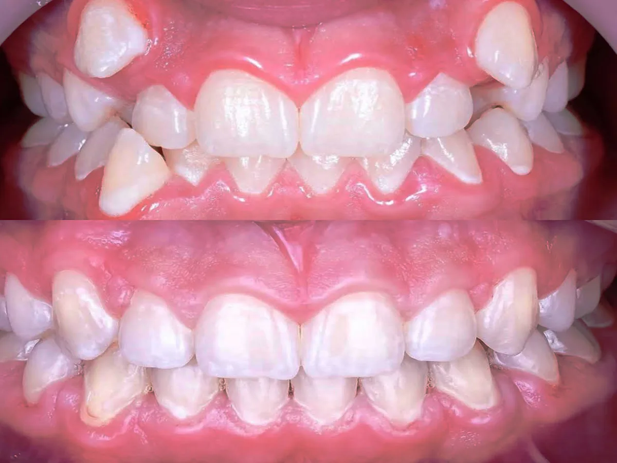 Teeth Braces