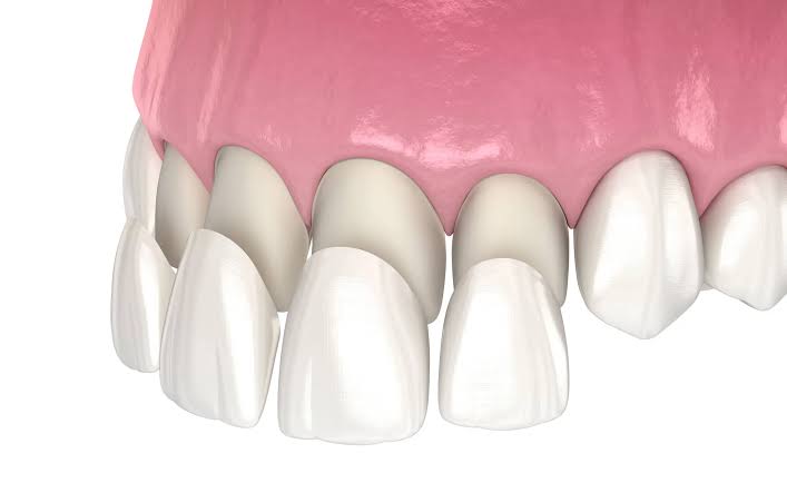 Veneers and Crowns