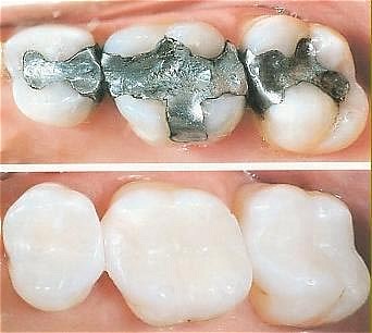 Tooth-colored filling treatment at Dr. Prerna Dental Hub