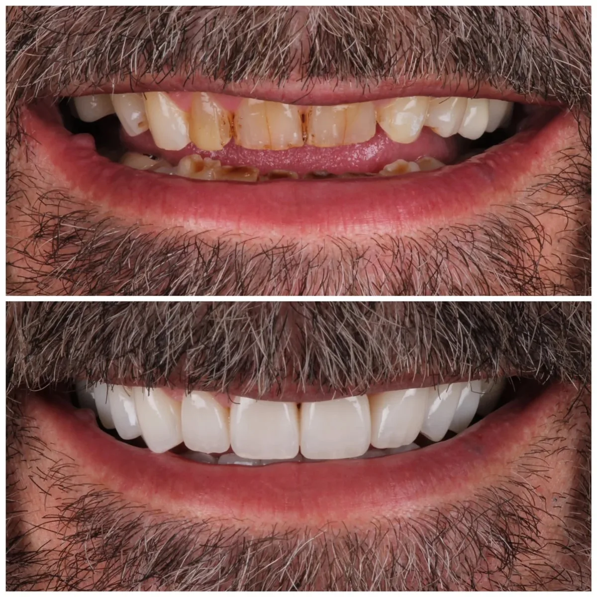 Full Mouth Rehabilitation
